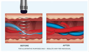 erectile dysfunction therapy